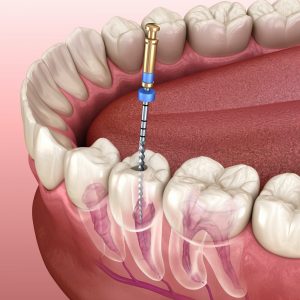 Root-Canal-Treatment in purnia